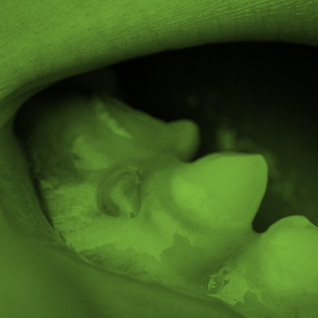 Ropień na dziąśle Ropień zęba Leczenie ropnia Zapobieganie ropniom Objawy ropnia Domowe sposoby na ropień Dentysta ropień Infekcja dziąsła Ból zęba Leczenie kanałowe Antybiotyki na ropień Zdrowie jamy ustnej Zapalenie dziąsła Higiena jamy ustnej Profilaktyka zdrowia zębów