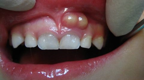 Ropień na dziąśleRopień zęba Leczenie ropnia Zapobieganie ropniom Objawy ropnia Domowe sposoby na ropień Dentysta ropień Infekcja dziąsła Ból zęba Leczenie kanałowe Antybiotyki na ropień Zdrowie jamy ustnej Zapalenie dziąsła Higiena jamy ustnej Profilaktyka zdrowia zębów